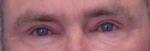 Blepharoplasty