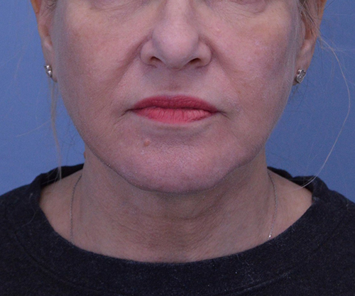 Face and Neck Lift