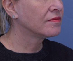 Face and Neck Lift