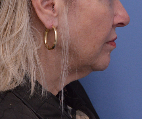 Face and Neck Lift