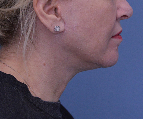 Face and Neck Lift