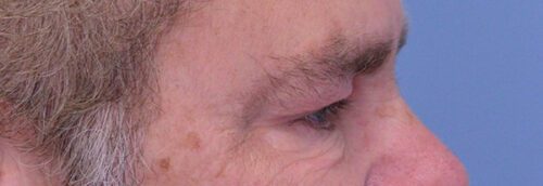 Endoscopic Brow Lift