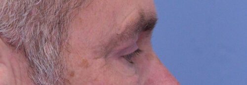 Endoscopic Brow Lift