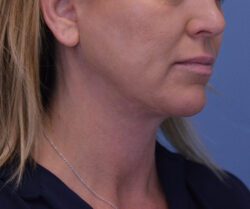 Face and Neck Lift