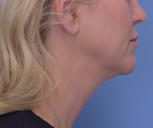 Face and Neck Lift