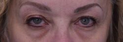 Blepharoplasty