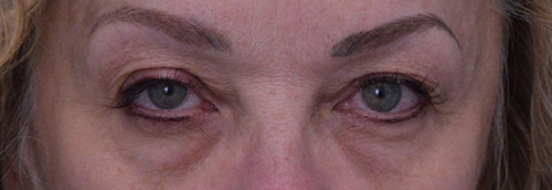 Blepharoplasty Case 19238 Before Photo Blepharoplasty