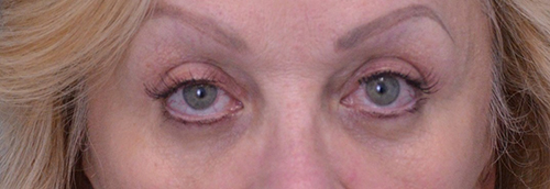 Blepharoplasty Case 19238 After Photo Blepharoplasty