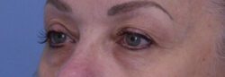 Blepharoplasty