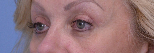 Blepharoplasty Case 19238 After Photo Blepharoplasty