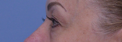 Blepharoplasty Case 19238 Before Photo Blepharoplasty