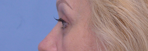 Blepharoplasty Case 19238 After Photo Blepharoplasty