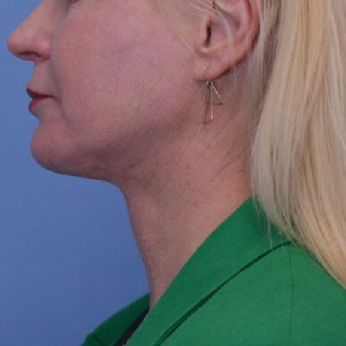 Face and Neck Lift