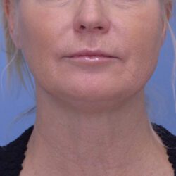 Face and Neck Lift