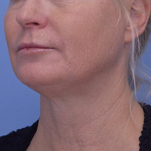 Face and Neck Lift