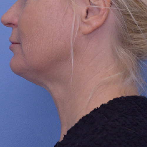 Face and Neck Lift