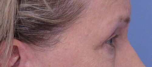 Blepharoplasty