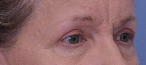 Blepharoplasty