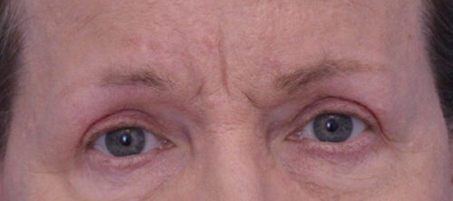 Blepharoplasty