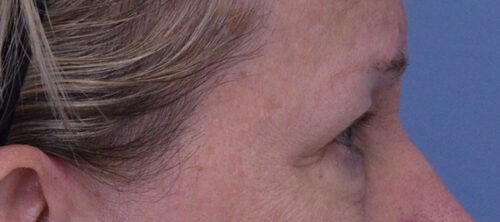 Blepharoplasty