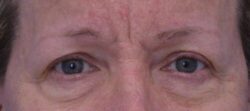 Blepharoplasty