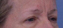 Blepharoplasty