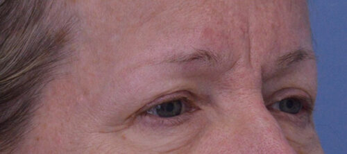 Blepharoplasty