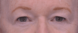 Blepharoplasty