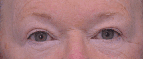 Blepharoplasty