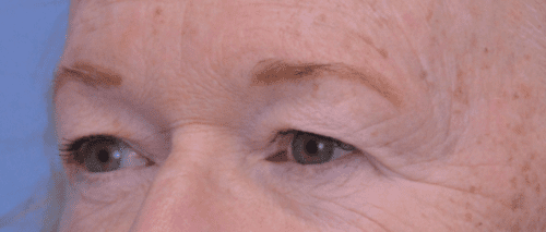 Blepharoplasty