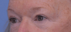 Blepharoplasty