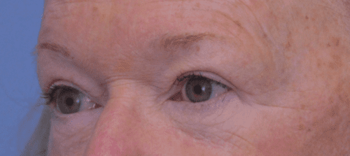 Blepharoplasty