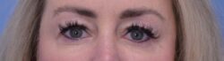 Blepharoplasty