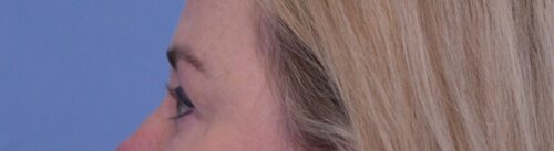 Blepharoplasty