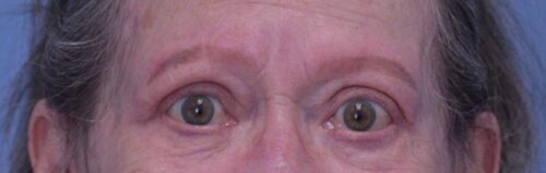 Blepharoplasty