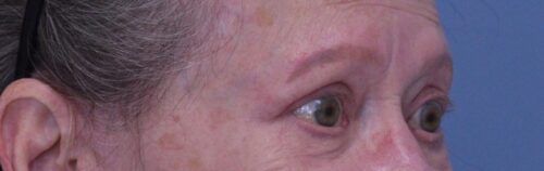 Blepharoplasty