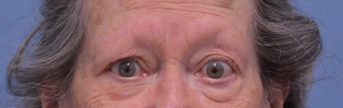 Blepharoplasty