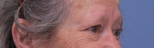 Blepharoplasty