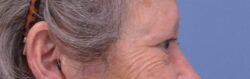 Blepharoplasty