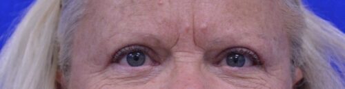 Blepharoplasty