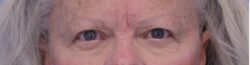 Blepharoplasty