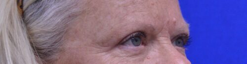 Blepharoplasty