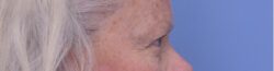 Blepharoplasty