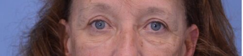 Blepharoplasty