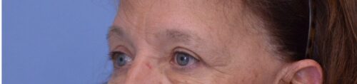 Blepharoplasty