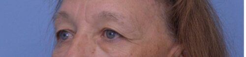 Blepharoplasty