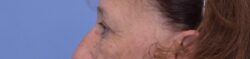 Blepharoplasty