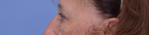 Blepharoplasty