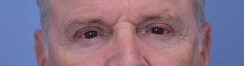 Blepharoplasty