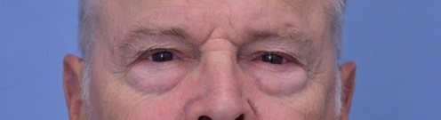 Blepharoplasty